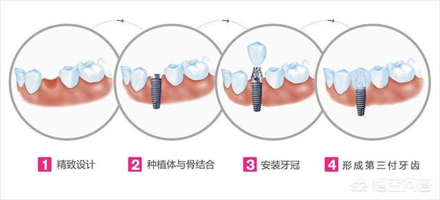 口腔种植牙流程是怎样的